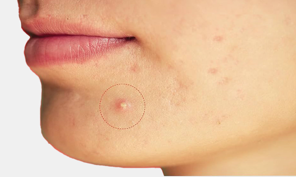 acne patches before